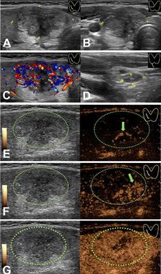 Multimodal predictive factors of metastasis in lymph nodes posterior to the right recurrent laryngeal nerve in papillary thyroid carcinoma